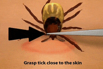Procedure for removing a tick